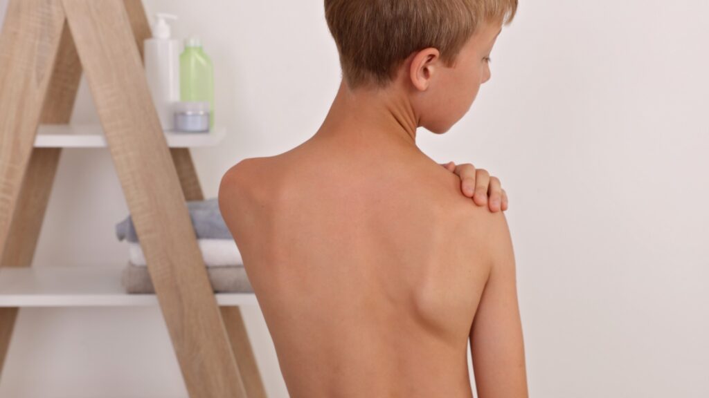 Odstające łopatki u dzieci